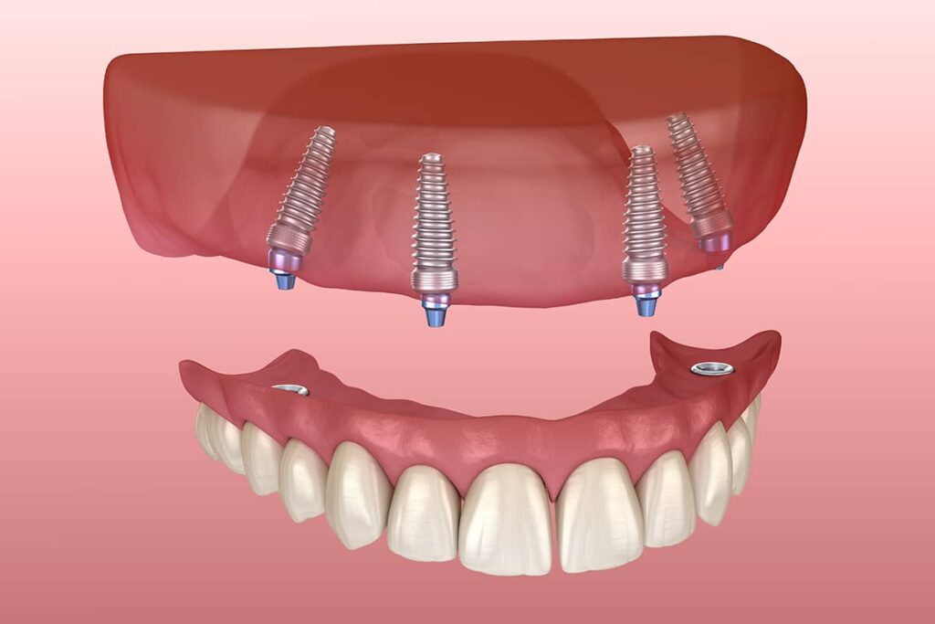 The cost of All-on-4 dental implants can vary greatly depending on the number of implants needed, the type of material used for the prosthetic teeth, and the overall complexity of the procedure