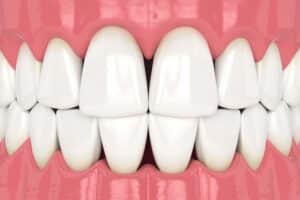 Black triangles can cause an unhealthy aesthetic to your smile and may increase your risk for plaque accumulation and tooth decay.