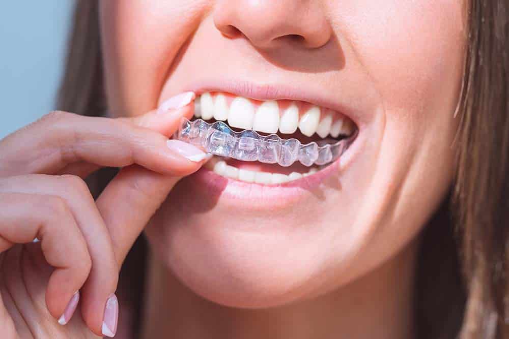 The Invisalign treatment process typically involves wearing custom-made aligners that are changed every two weeks to gradually shift the teeth into their desired position