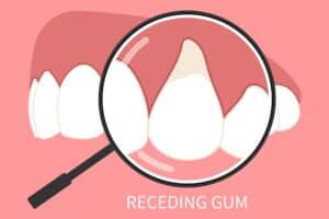 If left untreated, gum recession can cause tooth loss, bone loss, infection, and other serious dental health issues