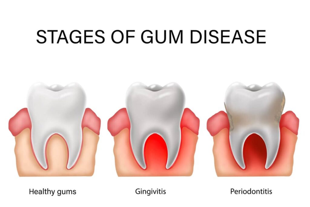 Advanced periodontitis is the most severe stage of gum disease, causing significant bone loss, deep periodontal pockets, and potential complete tooth loss