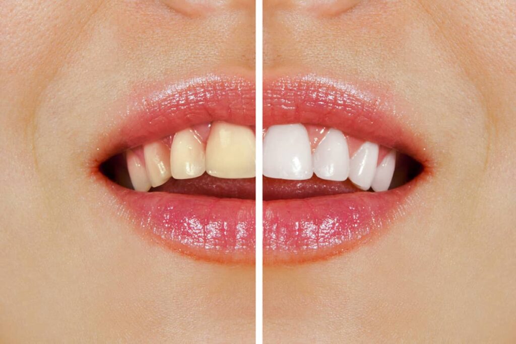 How to Make Your Teeth Whitening Results Last Longer Miami, FL