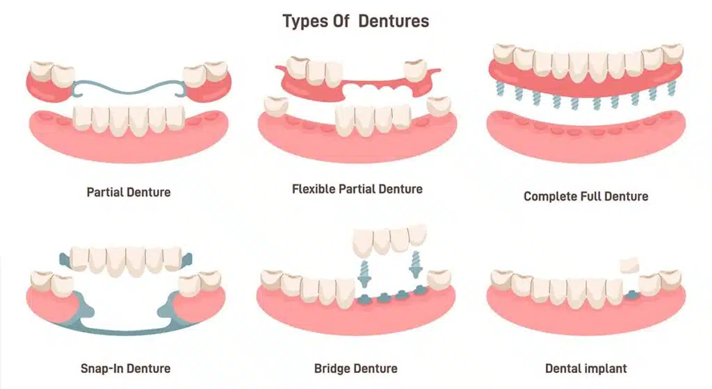 Partial dentures are available in a variety of materials, including cast metal, flexible, dental bridges, implant-supported, and acrylic dentures
