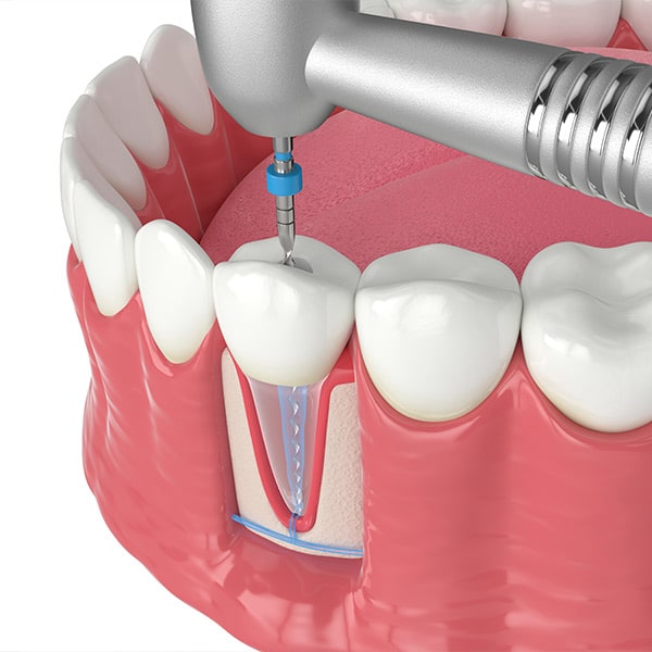 Endodontic treatment is used to treat the inside of the tooth.