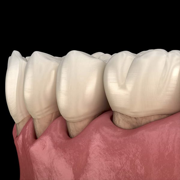 Gum recession often results in root sensitivity to hot and cold foods.