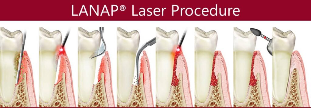 lanap laser procedure graphic