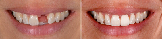 Single Tooth Replacement Before and After Photos in Miami, Florida, Patient 14697