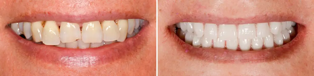 Teethxpress Before and After Photos in Miami, Florida, Patient 14708