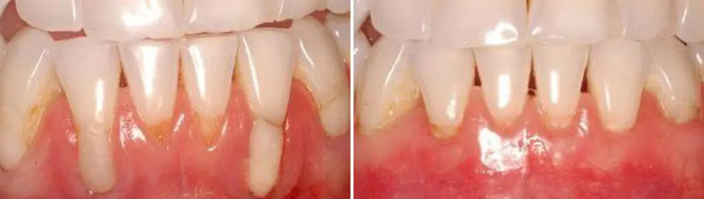 Gum Treatments Before and After Photos in Miami, Florida, Patient 14712