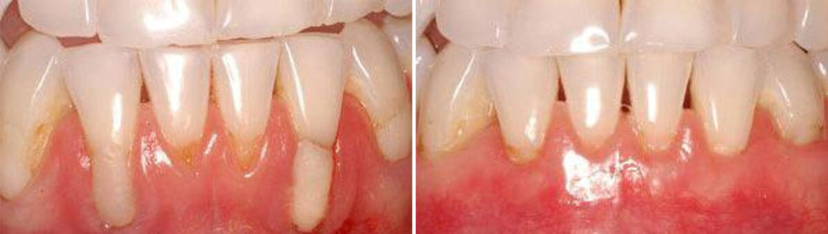 Gum Treatments Before and After Photos in Miami, Florida, Patient 14712