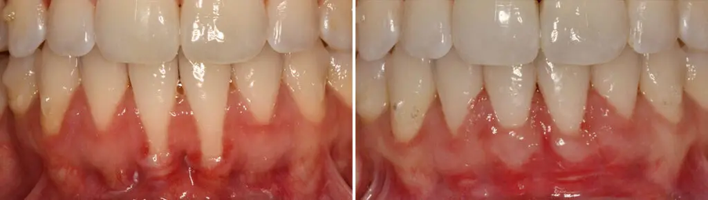 Gum Treatments Before and After Photos in Miami, Florida, Patient 14716