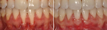 Gum Treatments Before and After Photos in Miami, Florida, Patient 14716