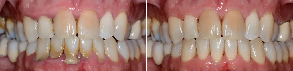 LANAP ® Before and After Photos in Miami, Florida, Patient 14720