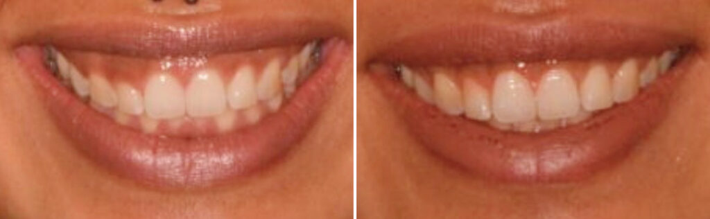 Lip Repositioning Surgery Before And After - Infoupdate.org