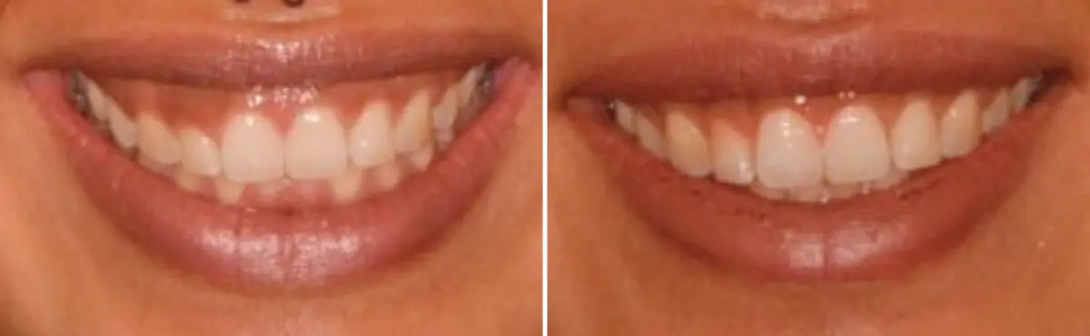 Lip Repositioning Before and After Photos in Miami, Florida, Patient 14730