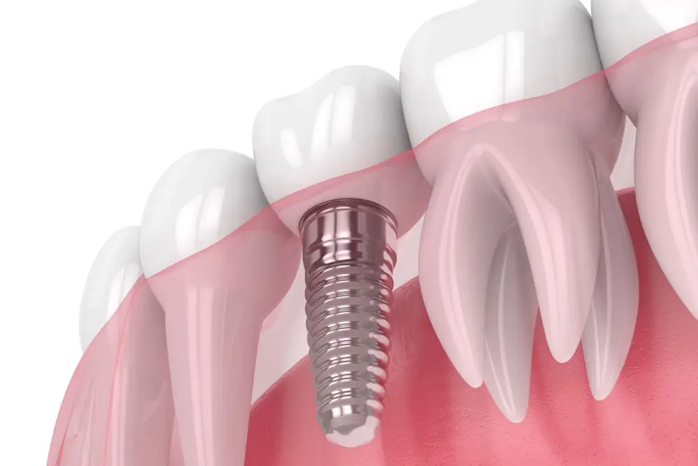 Single tooth implant refers to the replacement of a single missing tooth.