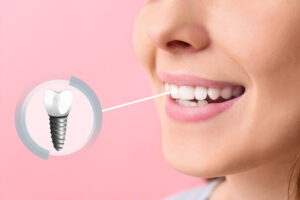 Patients in Miami, FL can undergo the dental implant process with Dr. Gallardo to restore their smiles and gain all the benefits of dental implants.