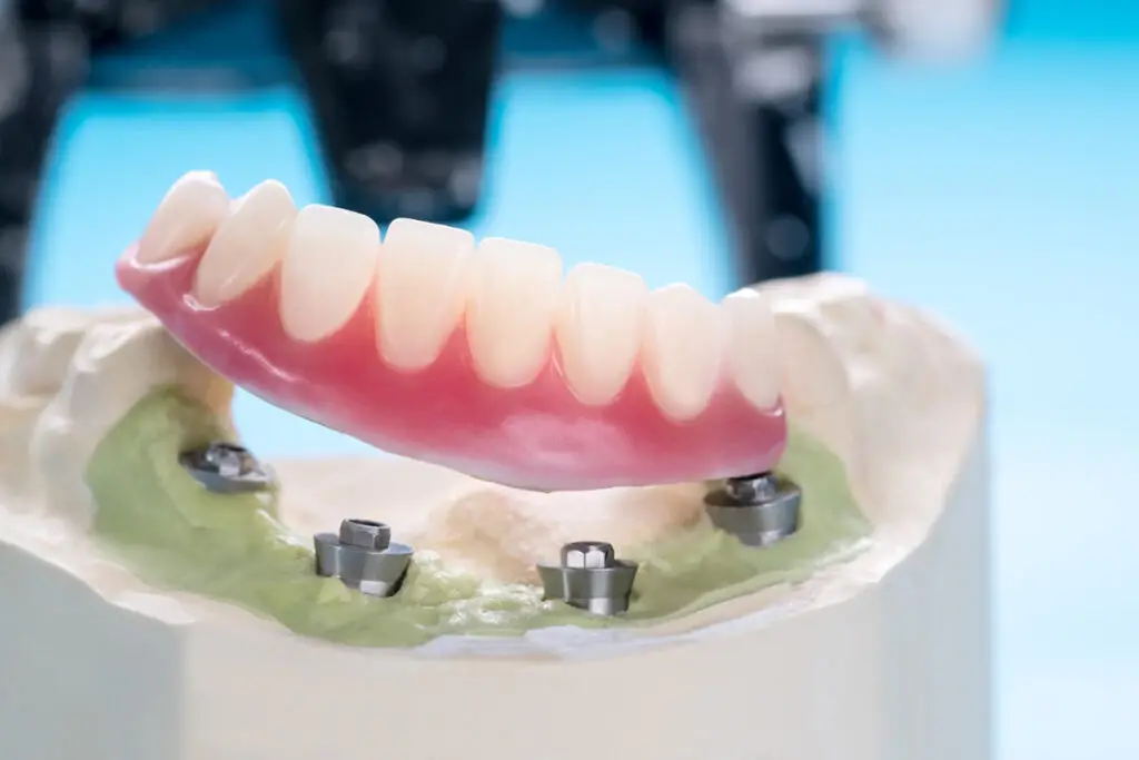 Implant-supported dentures are a permanent solution that provides more comfort and convenience in daily oral routines than traditional dentures.