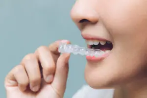 Close-up of a person inserting a clear Invisalign aligner to address dry mouth issues.