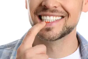 Close-up of a man's smile, highlighting healthy gums, representing professional dental care success.