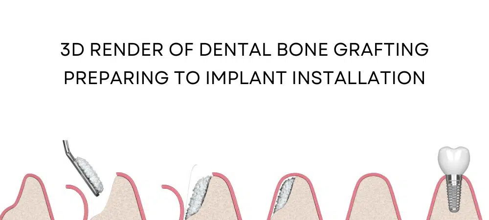 3D illustration showing the stages of dental bone grafting and implant installation in the jawbone.
