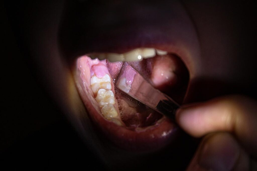 Zoom in to a pericoronitis case with the gums over the teeth.