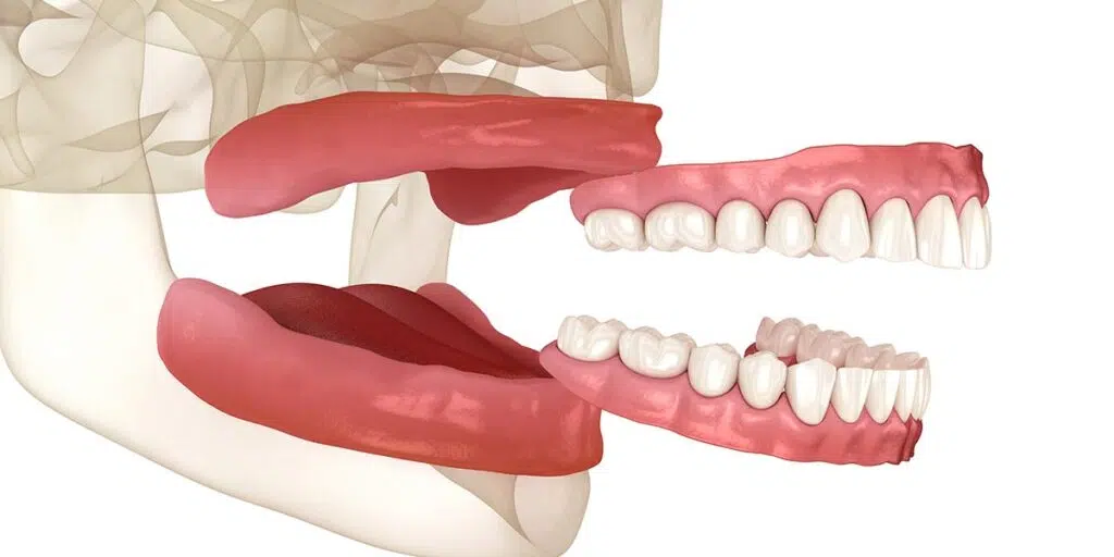 Complete Dentures
