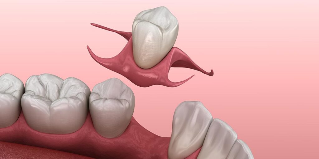 Immediate Dentures