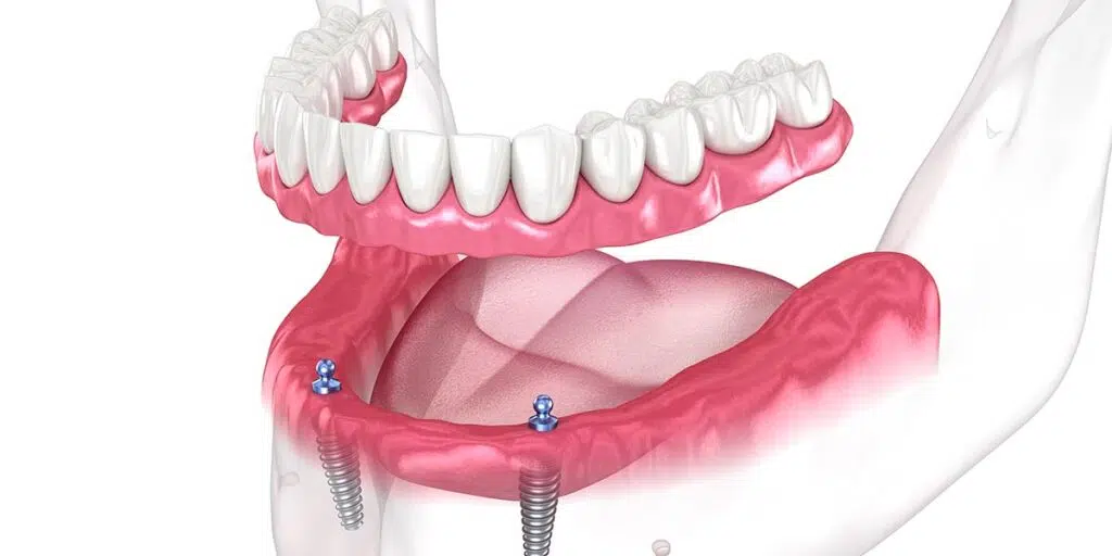 Implant-Supported Dentures