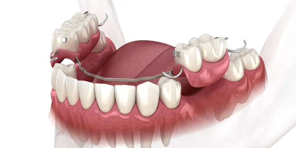 Partial Dentures