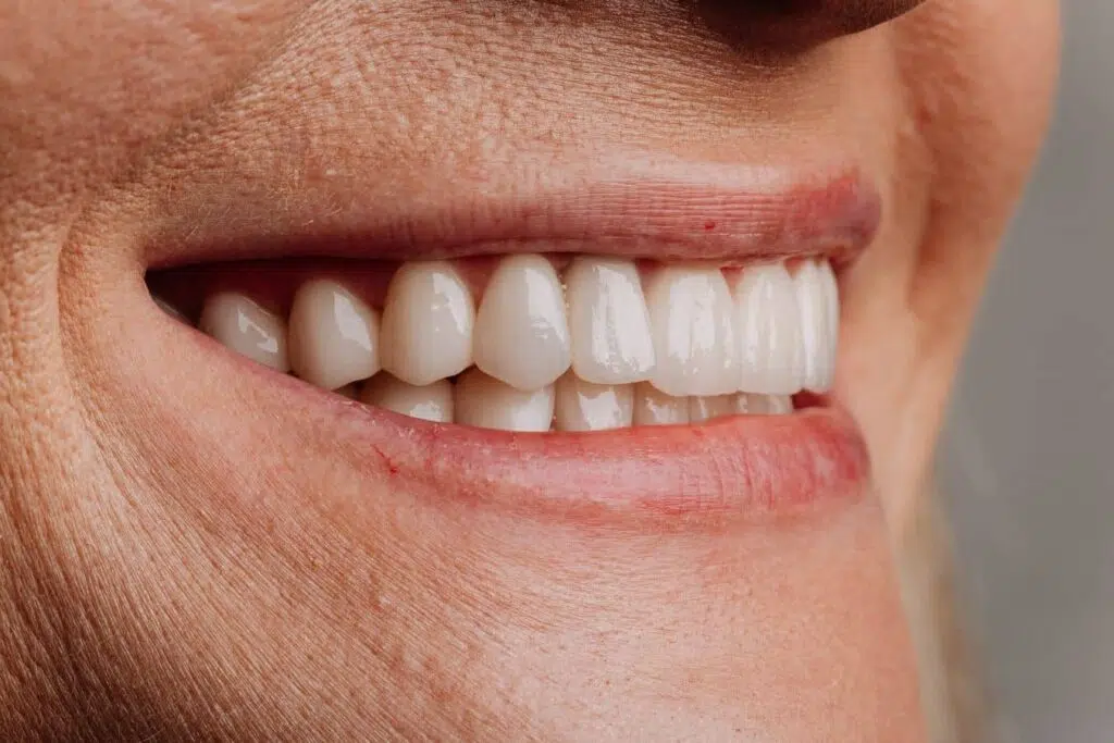 Healthy smile demonstrating cosmetic results of dental implants and bridge restoration options