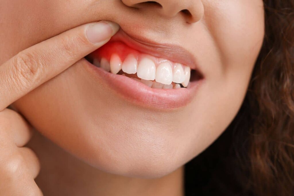 LANAP helps treat periodontal disease with less discomfort, reduced bleeding, and faster healing than traditional surgery.