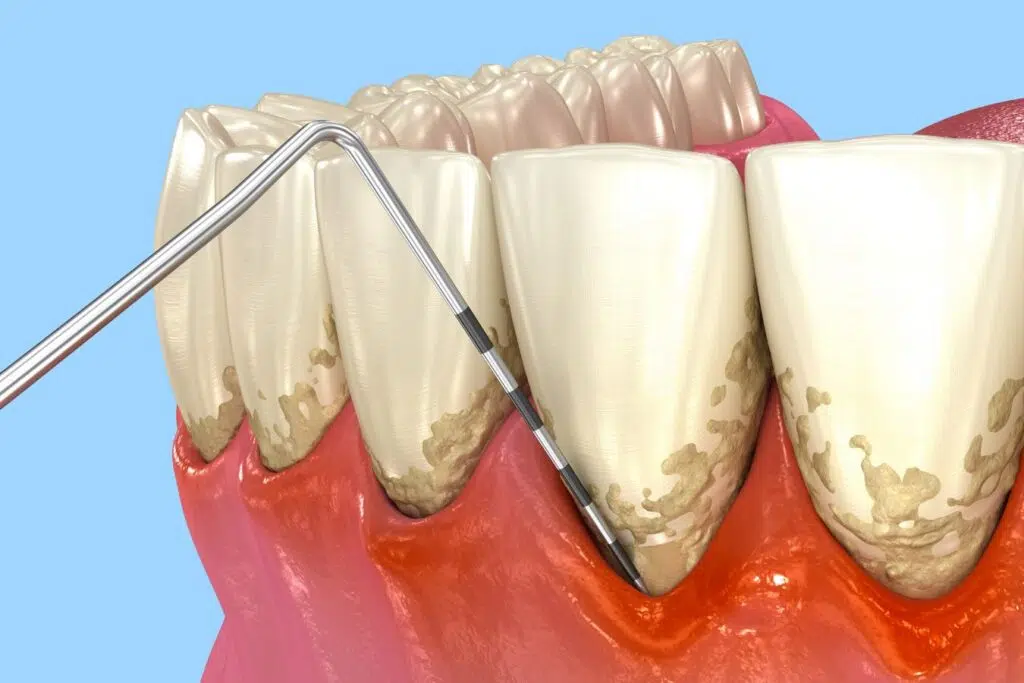 Dental scaler removing plaque below gumline during deep cleaning for advanced gum disease treatment