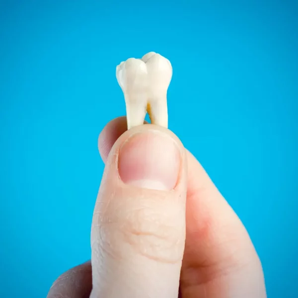 Tooth extraction is the surgical removal of a tooth from its socket.