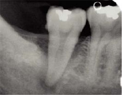 Mesial distal cracks on the lower right second molar