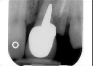 A pre-operative radiograph reveals tooth number 9 is fractured